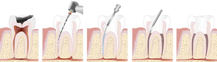 Wurzelkanalbehandlung